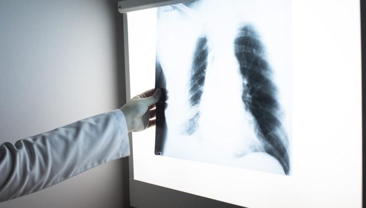 Dünyada erkeklerde en sık “akciğer”, kadınlarda da “meme kanseri” görülüyor