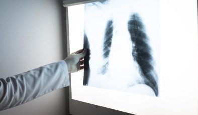 Erkeklerde En Sık “Akciğer”, Kadınlarda Da “Meme Kanseri” Görülüyor